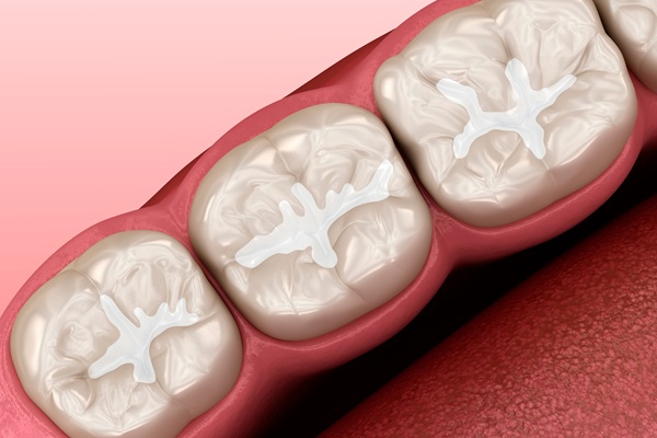 How Dental Sealants Can Protect Your Child’s Teeth